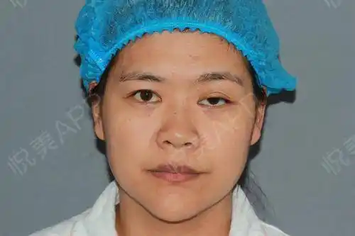 上睑下垂矫正术后5天_全切双眼皮术后5天_眼型矫正术后5天_眼综合术后