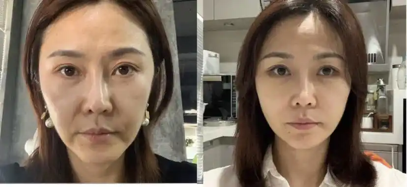 中下面部拉皮除皱前后对比