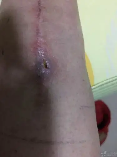 线结反应 - 感染 -丁香园论坛