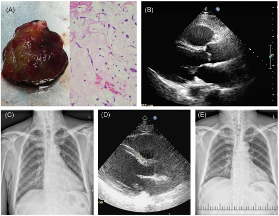 胸闷呼吸困难引流出乳糜样胸腔积液罪魁祸首令人惊讶