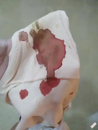 早上起身内裤出了挺多血的,去完小便起来,又滴了