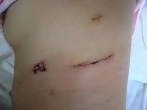 由于手术难度不大,不需要锯开胸骨,所以不会留下影像美观的疤痕,手术