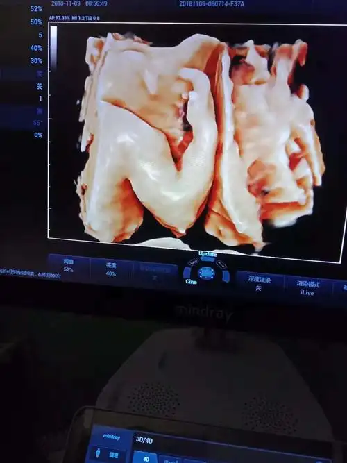 13孕周胎儿也可以这么清晰