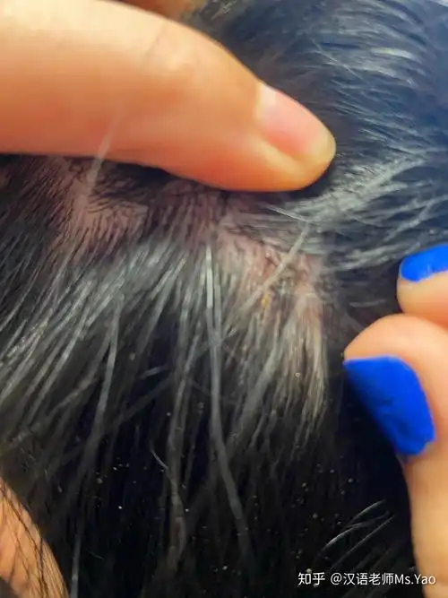 一直挠头头上有许多结痂怎么能不挠这是怎么回事而且挠完扣下结痂会有