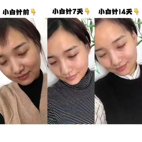 打美白针全身美白好么_激光美白和打美白针哪个好_成都打美白针要多少