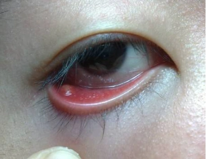 眼睛麦粒肿初期图片7