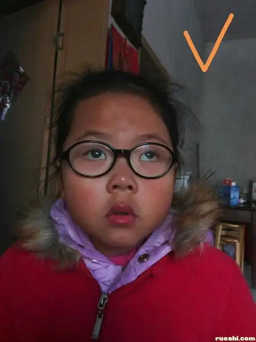 20180117报名分析5岁单眼近视弱视间歇性外斜垂直上斜