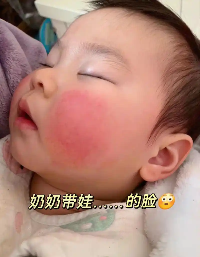宝宝的小脸蛋要呵护呦