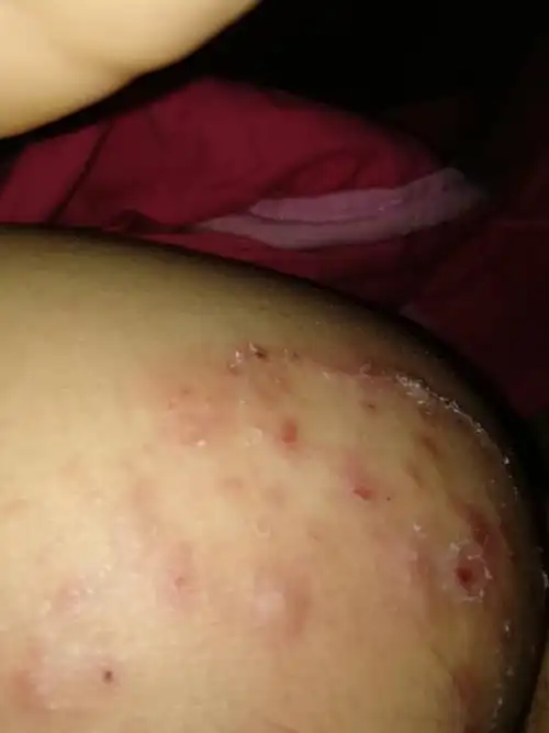 臀部最近痒得很这是怎么回事啊更空挡裸睡有没有关系啊怎么办急