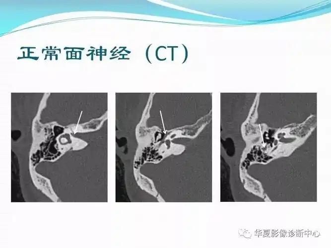 面神经解剖及常见病变影像诊断