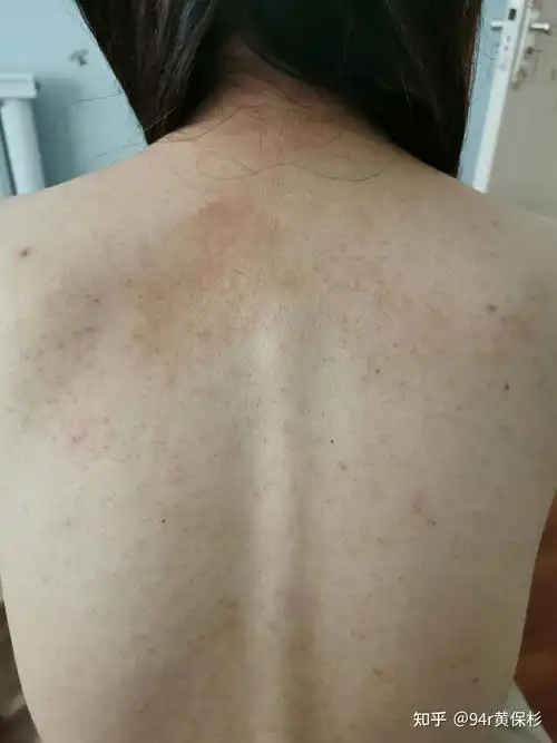 毛囊炎的症状是什么样子的怎样治疗