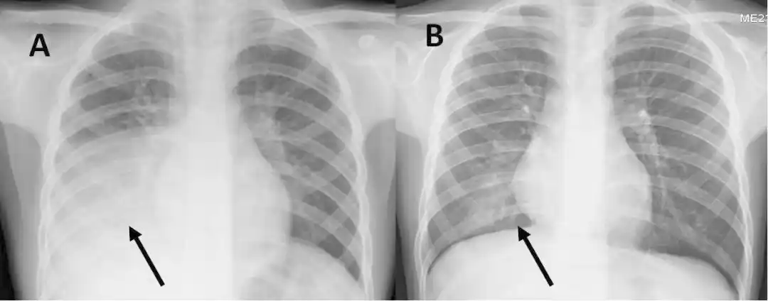 音不对称或者中细湿啰音那肯定得拍张胸片以确定肺部感染的范围和程度