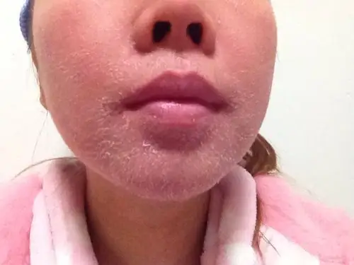 我的脸死皮非常重要,去医院看医生说皮肤受损严重,要求我住院,我没有