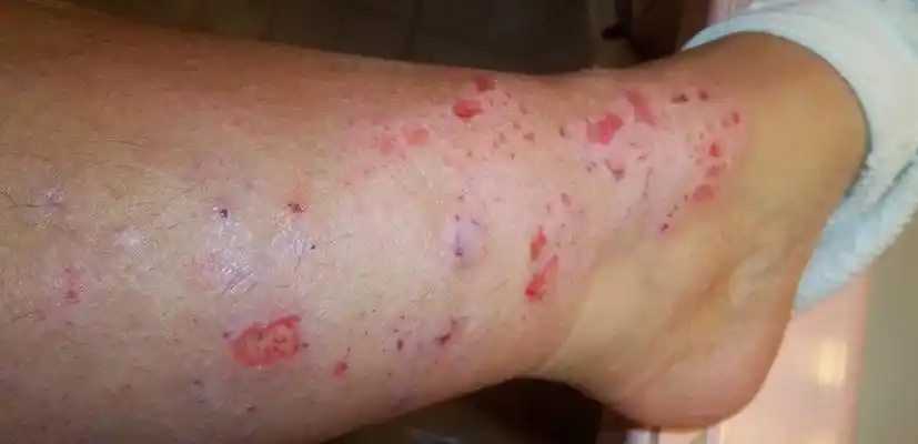 艾滋初期皮疹图片45