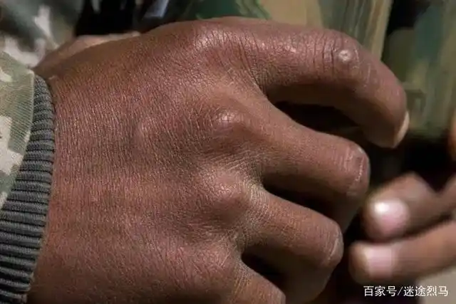 让人泪目:粗糙不堪的九零后边防军人的"老年手"