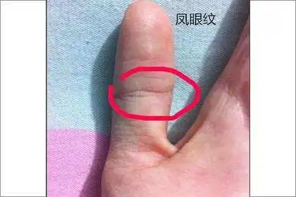 凤眼纹不封闭穷一辈子是真的吗