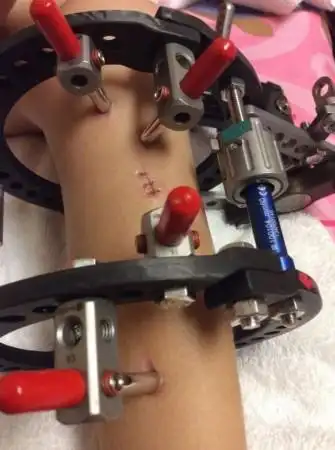 女孩左腿短11厘米被断腿300多次