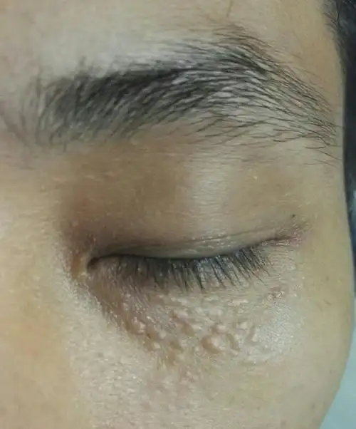 10   130****0617我有更好的答案 5条回答 脂肪粒,可以激光去除  湖州