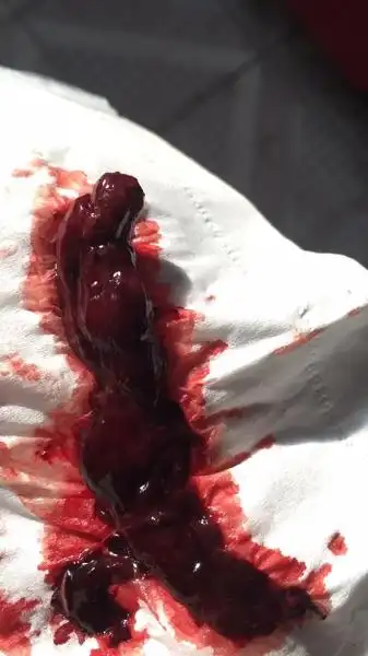 请问我这是胎儿吗?我药流第四天排出的