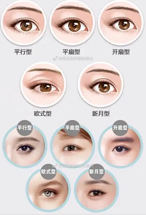 双眼皮手术_双眼皮手术治疗介绍 - 好大夫在线