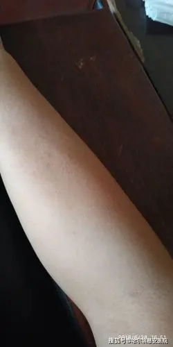 太阳晒得胳膊痒是紫外线灼伤皮肤,出现日光性皮炎.