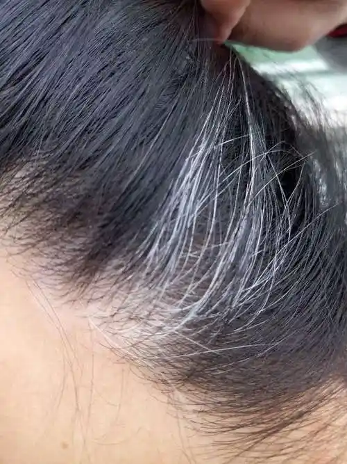 这两天才发现在脑袋左侧有白发,这里是不是也是白癜风.