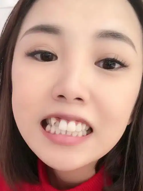 虎牙在别人眼里很可爱 可是我却十分不喜欢我这个牙 _圈子-新氧美容