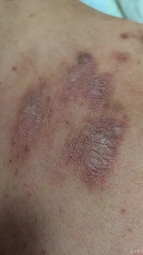 皮肤溃烂一直不好