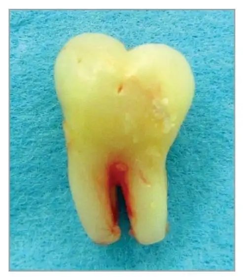下颌第二磨牙萌出前冠内吸收一例
