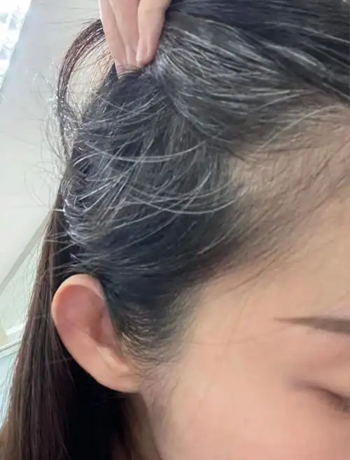 26岁就有白头发显老又没气质有什么办法挽救吗