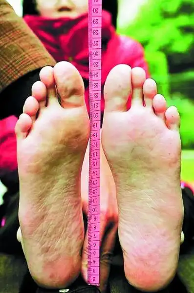 福州12岁女孩穿不下43码鞋患马凡氏综合征图