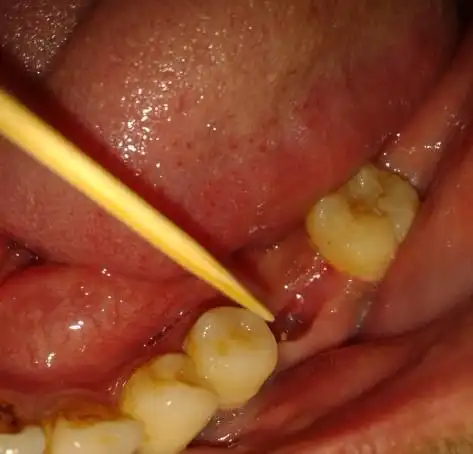 牙齿拔了一个月之后,拔掉的那个洞里突然多出这么个玩意儿.