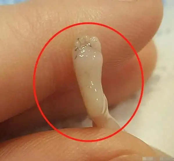 宝妈怀孕14周意外流产,"胎儿"模样曝光!才10厘米但手脚已成形