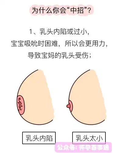 乳头皲裂,这酸爽,你绝对想象不到
