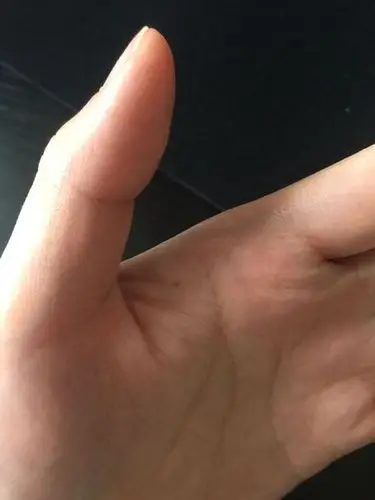左手虎口处突然长了颗痣(以前没有)