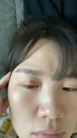 上眼皮长了一个肉疙瘩,硬硬的怎么回事?有没有发生过的