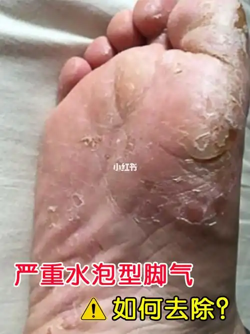 干货|脚气18天去除水泡型脚气!脚痒没有啦