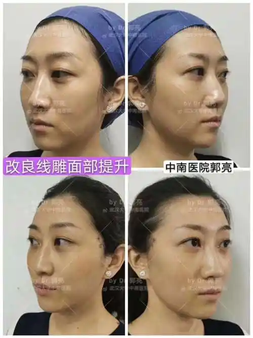 讯】8月2日有武汉大学中南医院专家来我院皮肤美容科开展整形美容手术