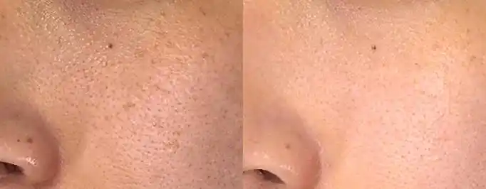针对毛孔粗大3次治疗(平扫模式 蜂巢模式)前后对比图