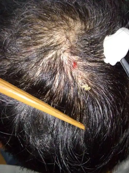 又疼又痒的头皮小疙瘩来袭?这几件事做到位,就能有效缓解_手机搜狐网