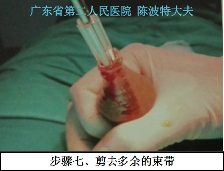 图解一次性包皮环切缝合器手术过程