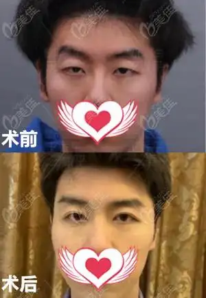 大连王香平做男士双眼皮效果好吗请看真人对比照分享