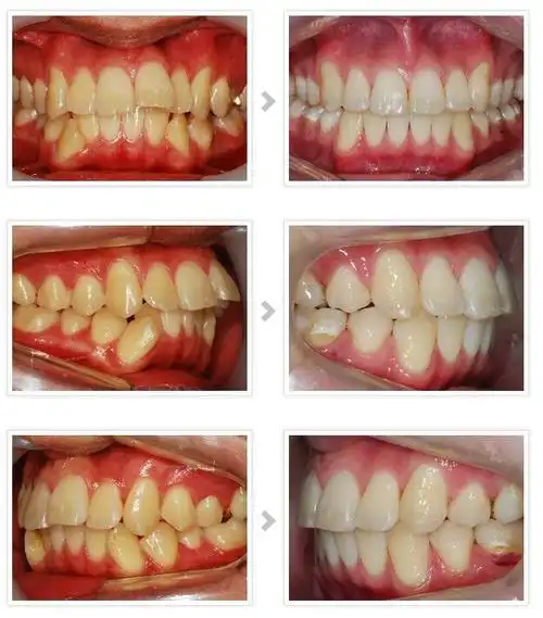 仿生美牙冠做牙齿修复,不仅可以不用拔牙,而且也不用担心戴牙套的烦恼