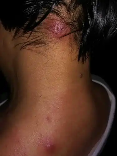 6.26日晚拍的症状:1.气短2.皮肤病(疮/血毒)两星期前犯的3.