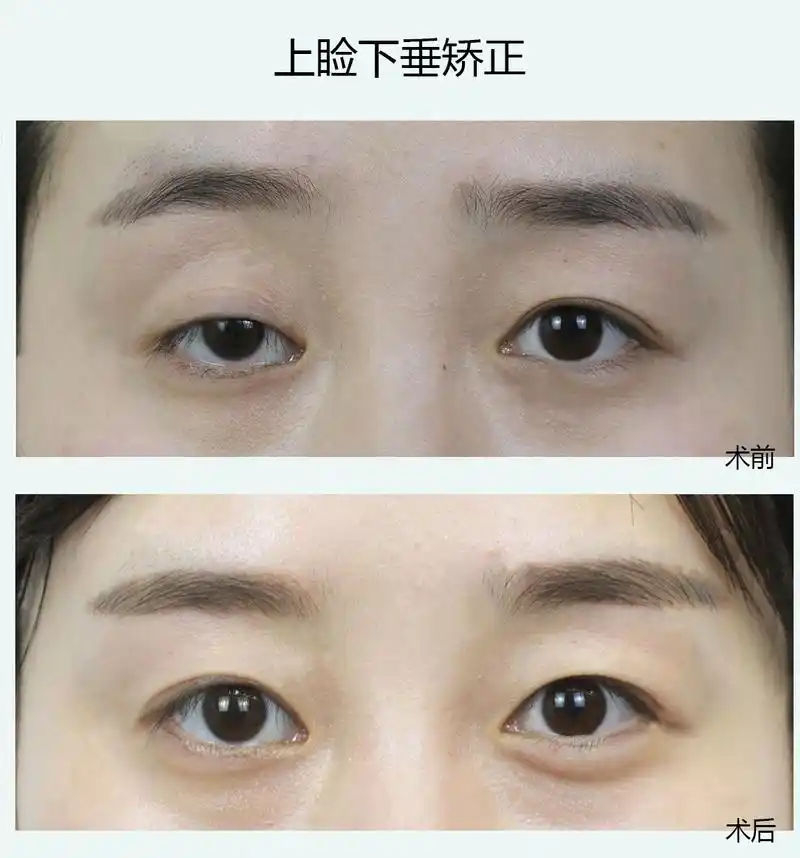 余文林上睑下垂的原因上睑下垂如何矫正