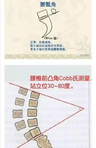 腰骶角增大,反应腰背部肌挛缩