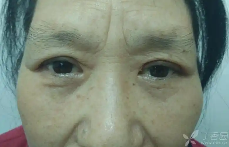 【讨论】上睑皮肤松弛的改进方法 [病例帖]