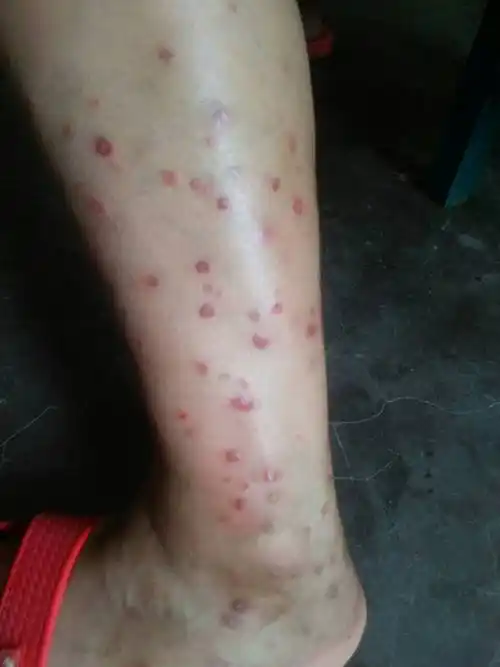 很痒,只有小腿上有.