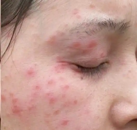 皮肤过敏及感染处理的小知识