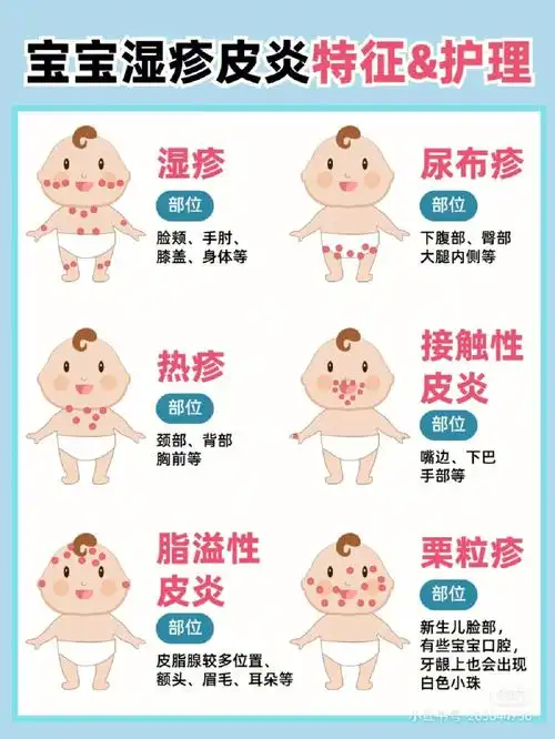 湿疹热疹痱子怎么区分7571护理大全75